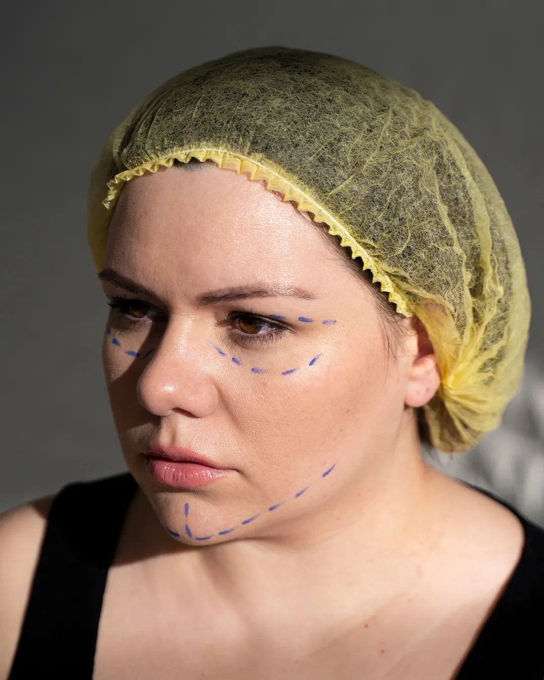 Facelift
