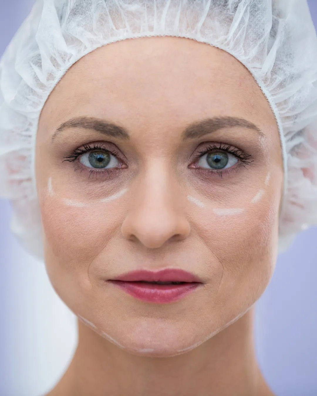Eyelid Lift